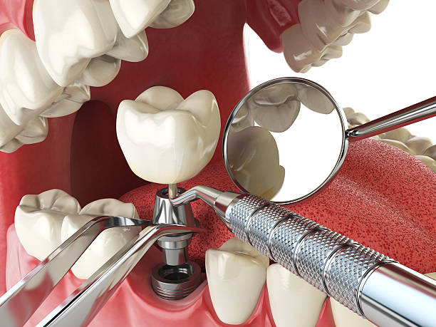 Best Emergency Cosmetic Dentistry (e.g., broken veneers) in Lake Holiday, IL